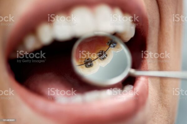 linguale Zahnspange hannover