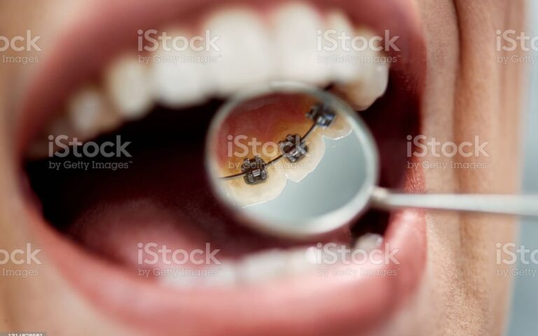 linguale Zahnspange hannover