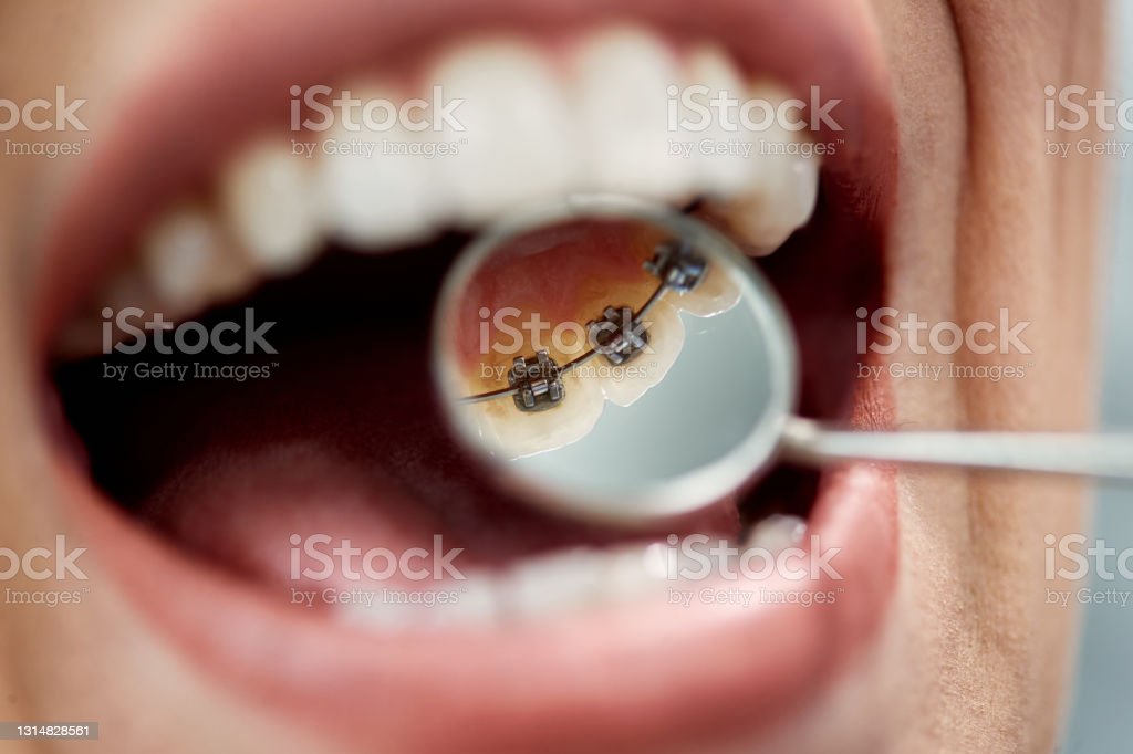 linguale Zahnspange hannover